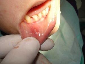 Стоматит во рту — чем лечить? Основные симптомы болезни
