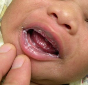 Как вылечить детский стоматит