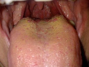 Желтый налет на языке у ребенка – болезнь или симптом?