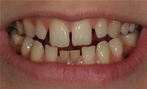 Диастемой называют промежуток между передними зубами