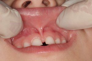 Визуальный осмотр у стоматолога может выявить диастему