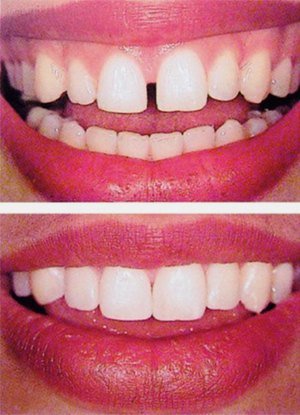 После лечения диастемы от щелей между зубами не остается и следа.
