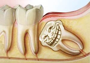 Показания к удалению зуба 