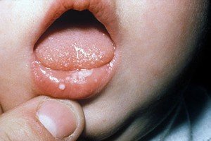 Проявление стоматита на губе