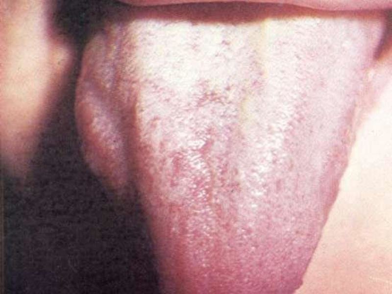 Заболевание полости рта
