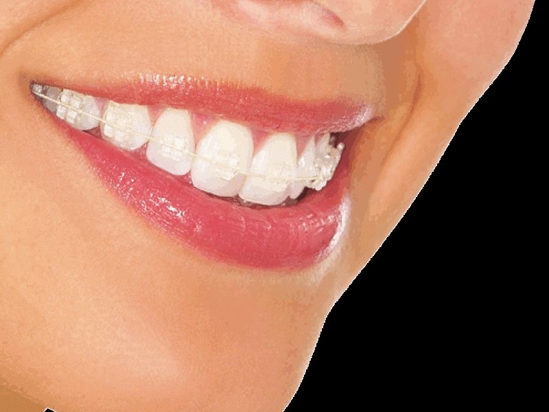 Описание керамических скоб для коррекции расположения зубов