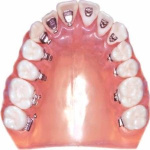 Характерное описание внутренних брекетов для коррекции зубов