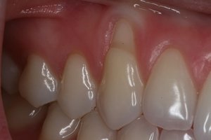 Корень зуба: оголение