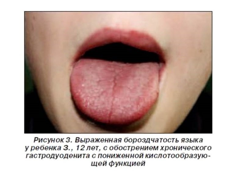 Борозчатый язык также является признаком болезней