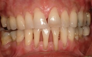 Причины оголения корня зуба