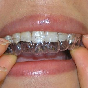 Отзывы о капах для выравнивания зубов
