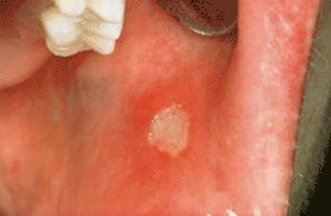 Причины, лечение и фото белых язвочек у ребенка во рту