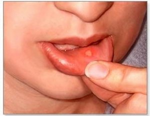 Как лечить белые язвы во рту