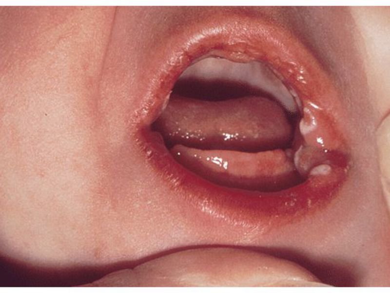 Заболевание полости рта