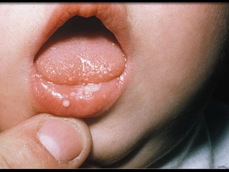 Чем помочь ребенку при язвах во рту