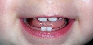 Уход за молочными зубами
