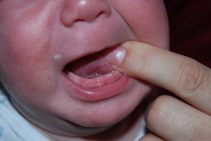 Симптомы прорезывания зубов у грудничков