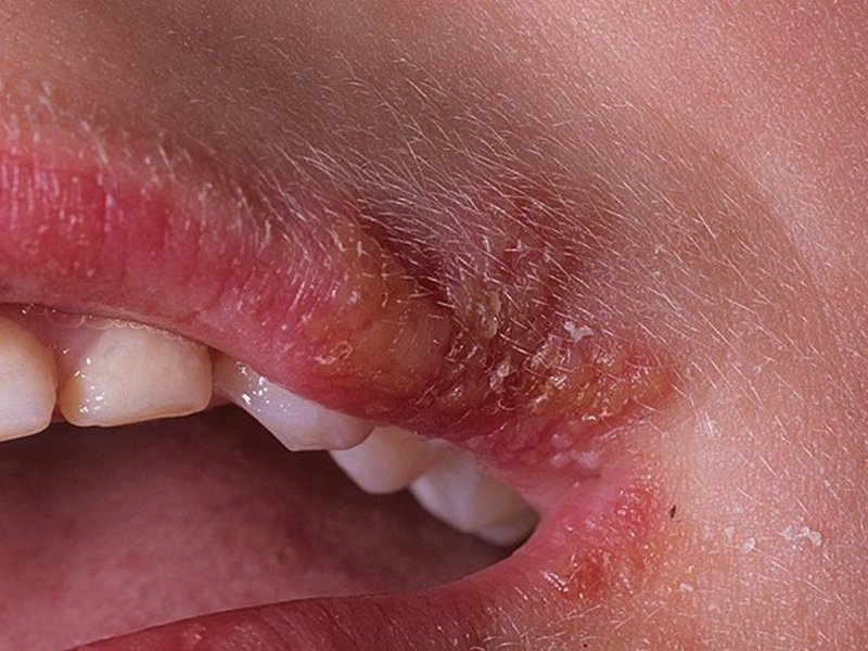 Вирус герпеса на уголках губ