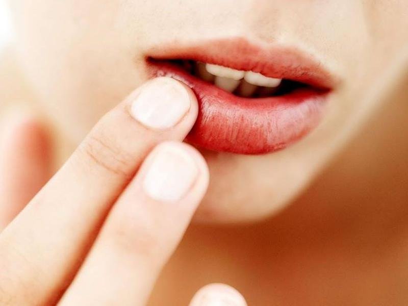Описание признаков появления вирусного заболевания губ