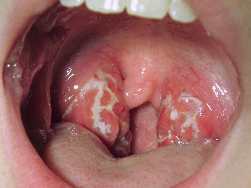Особенности того или иного вида кандидоза полости рта