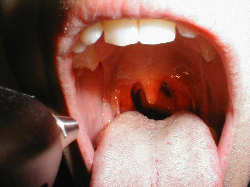 Перечень симптомов разновидностей грибкового заболевания полости рта
