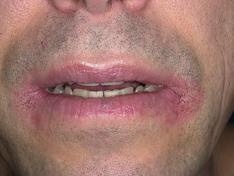 Заболевание на углах губ