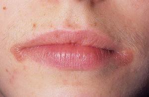 Как выглядят хейлиты на губах