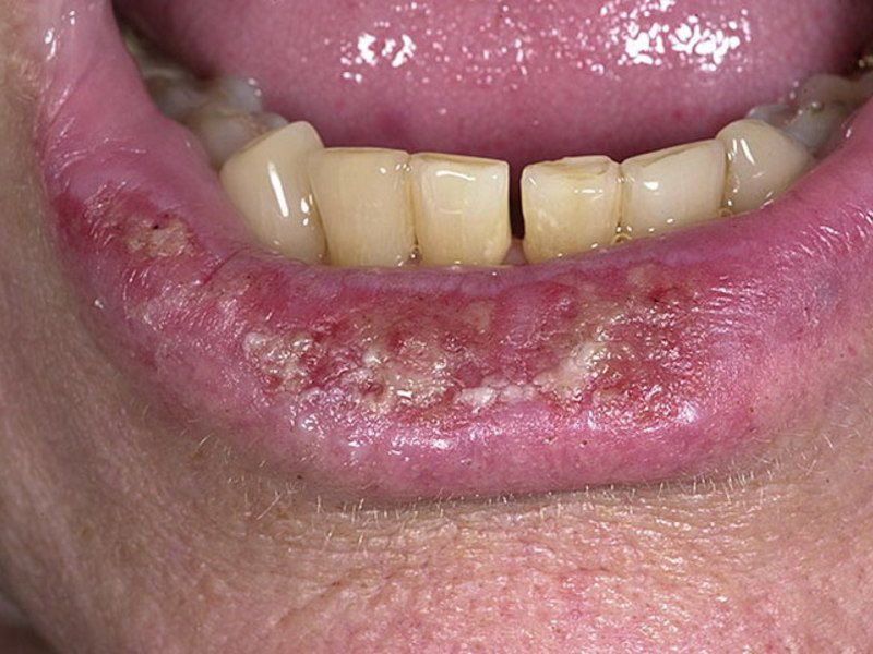 Воспаленные губы