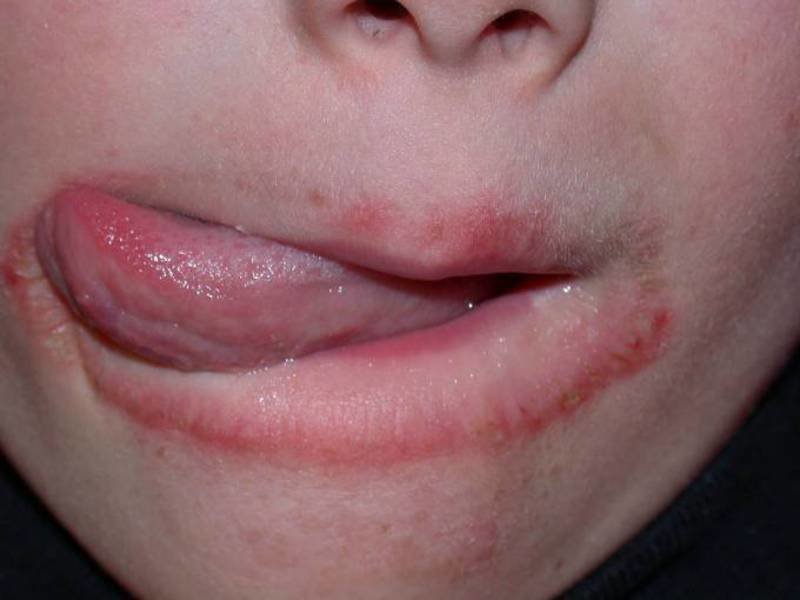 Воспалительные бляхи на губах