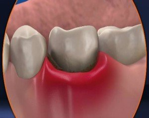По каким причинам зуб отходит от десны