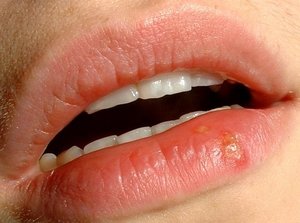 Герпес на губах — как вылечить болячку