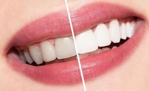 Особенности отбеливания зубов