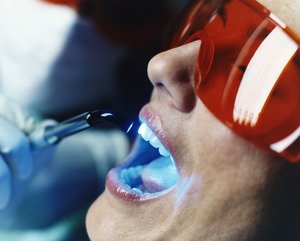 Технологии по отбеливанию зубов