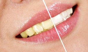 Какие средства хороши при отбеливании зубов