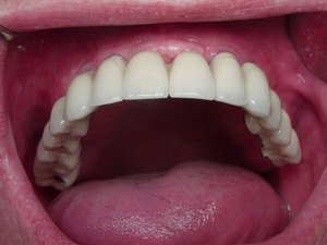 Сколько каналов находится в верхних и нижних зубах