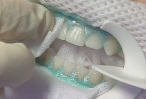 Как отбеливают зубы дома