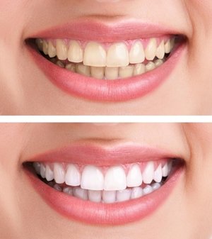 Метод отбеливания зубов