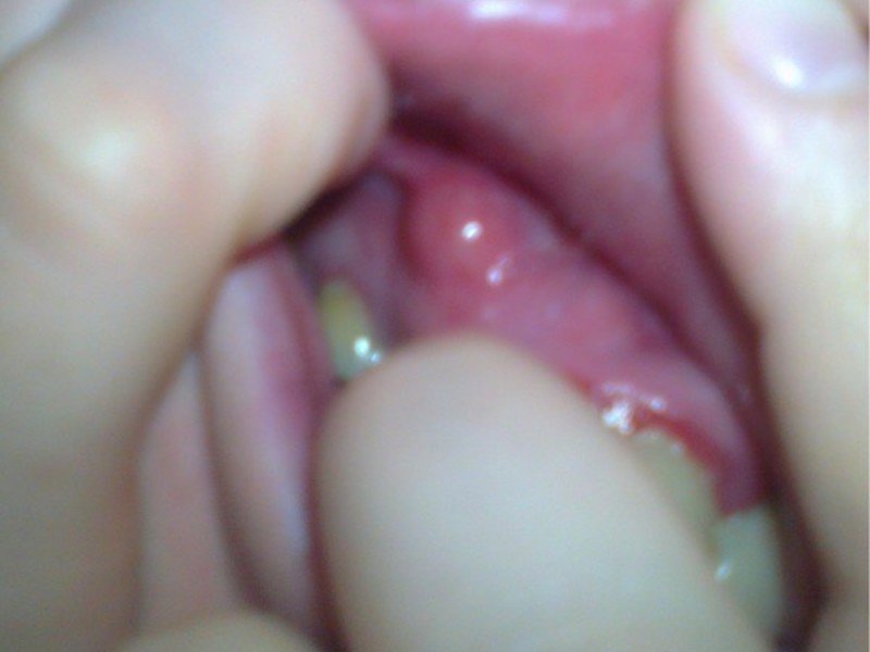 Опухоль возле зуба