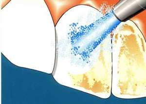 Как влияет ультразвук на зубы