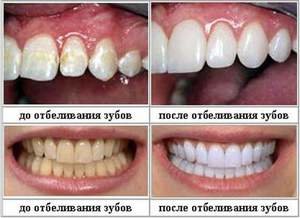 Отзывы об отбеливании зубов в стоматологии