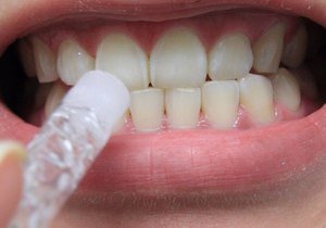 Как отбелить зубы дома