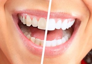 Рекомендации по отбеливанию зубов