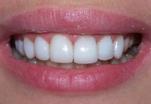 Способы отбеливание зубов дома