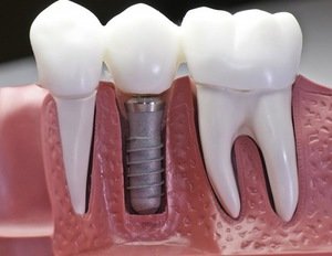 Как делают имплант на зуб