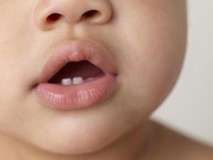 Как облегчить страдание ребенка при прорезывании зубов