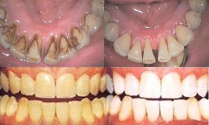 Способы профессиональной чистки зубов, фото процесса
