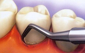 Методики профессиональной чистки зубов