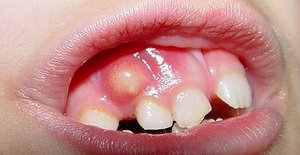 Что представляет собой воспаление надкостницы зуба